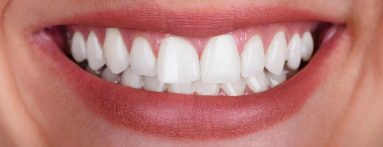 After Using My Pearl Teeth Whitening